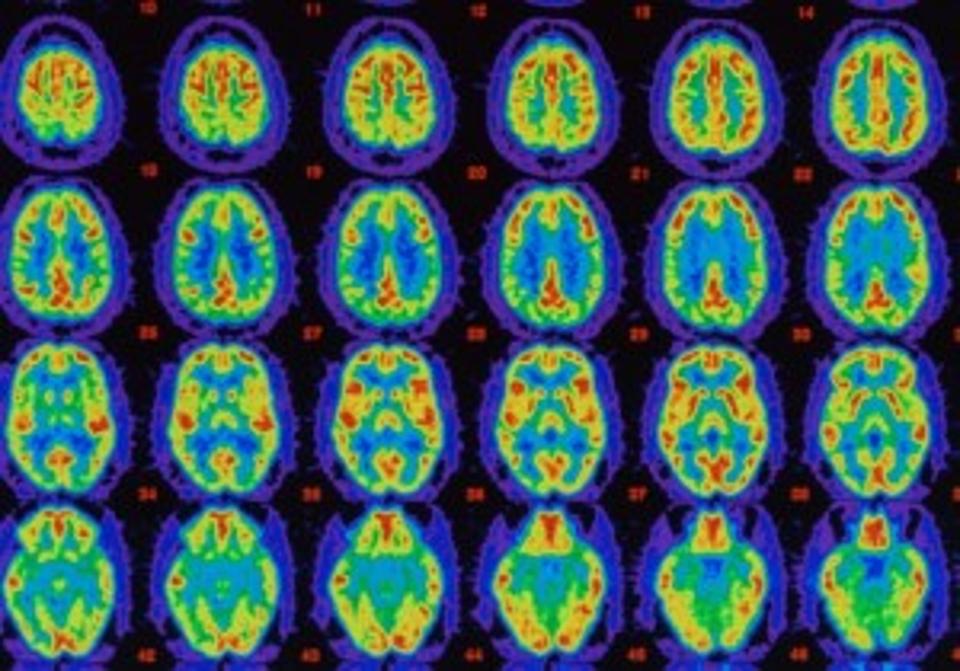 brain scans forbes study football